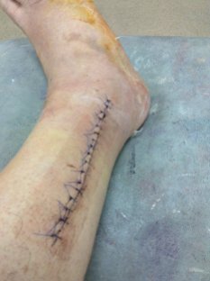 An impressive scar with 17 stitches.